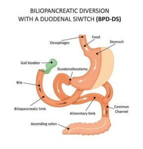 Duodenal Switch (DS)