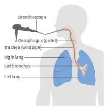 Having a Bronchosopy