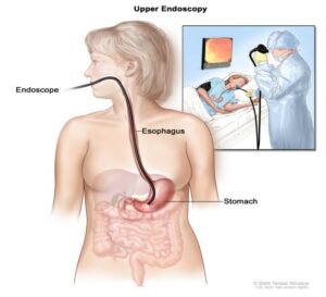 Colonoscopy diagram