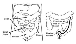 Flexi-Sigmoidoscopy diagram