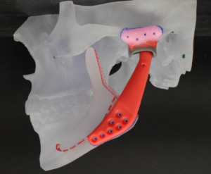 3D model of a jaw with the prosthetic added