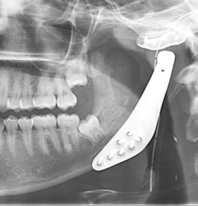 x-ray showing the jaw prosthetic in place post-surgery