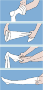 https://www.bedfordshirehospitals.nhs.uk/wp-content/uploads/2023/10/How-to-put-on-stockings-correctly-demonstration-144x300.png