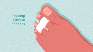A graphic demonstrating toe strapping