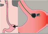 Capsule dissolving in the stomach