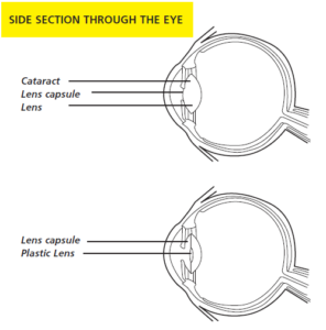 Image shows side section through the eye. Image points to cataract, lens capsule and lens