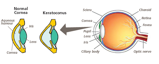 Image showing a normal cornea and Keratoconus