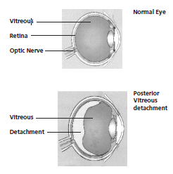 Diagram showing a normal eye and a Posterior vitreous detachment