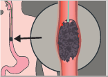 The sponge collecting cells in the gullet as it is removed