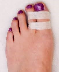 Toe strapping demonstrated with bandages