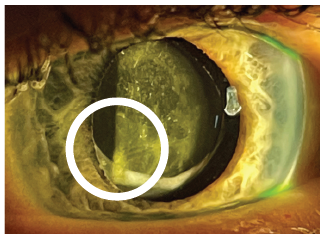 An opening is made in the middle of the cloudy membrane with the laser