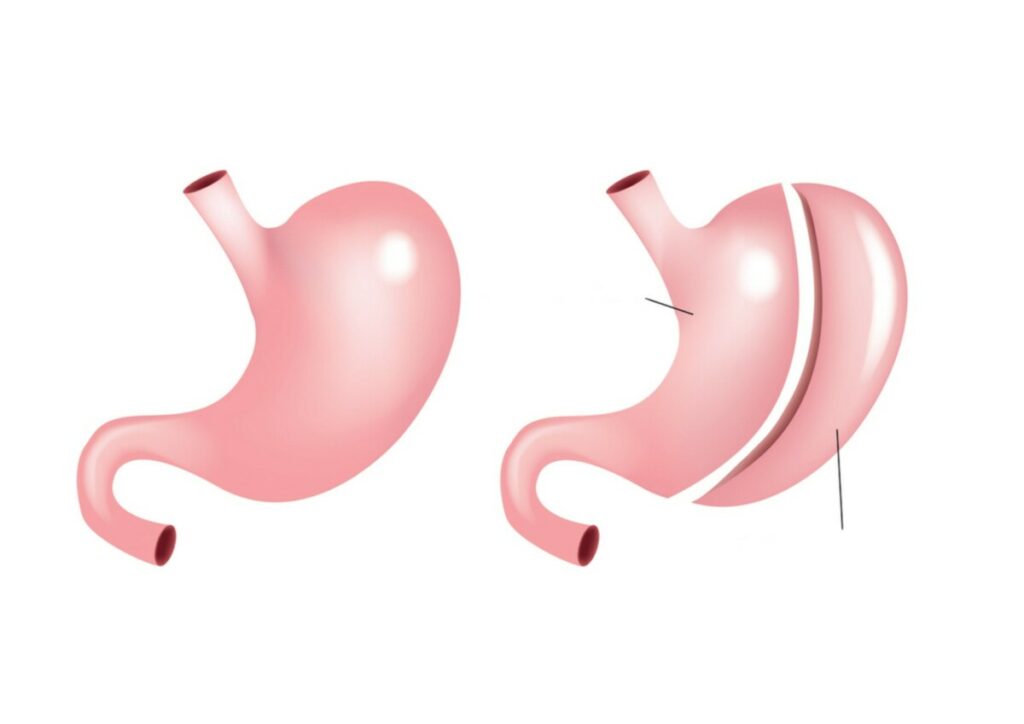 Diagram of Laparascopic Sleeve Gastrectomy