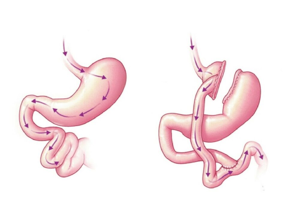 Diagram of Laparascopic Roux –en-Y gastric bypass