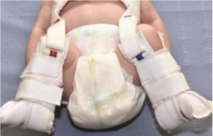 Baby wearing pavlik harness