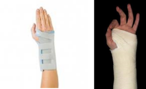 An arm in a splint, and an arm in a cast