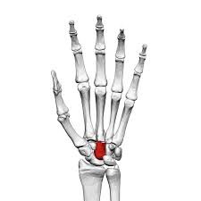 Carpal bone Avulsion Fracture diagram