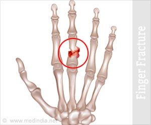Finger fracture diagram