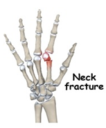 Metacarpal neck fracture diagram