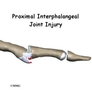 Proximal interphalangeal joint injury diagram
