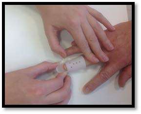 Mallet finger - NHS