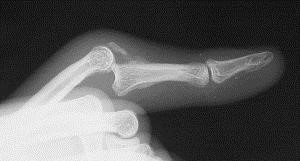 Volar Dislocation x-ray