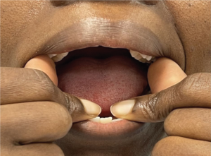 Gently stretching mouth open