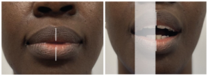 Measuring the line of your jaw opening